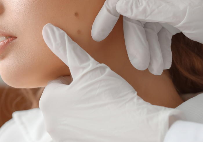 Laugh｜シミ・イボ取り対応の隠れ家エステ